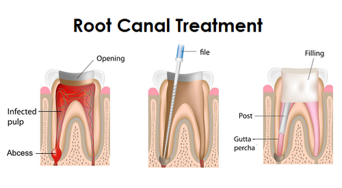 root-canal-treatment (1)
